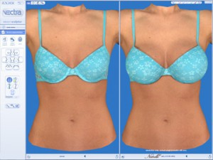VECTRA® 3D Imaging for Laser Bra Breast Surgery